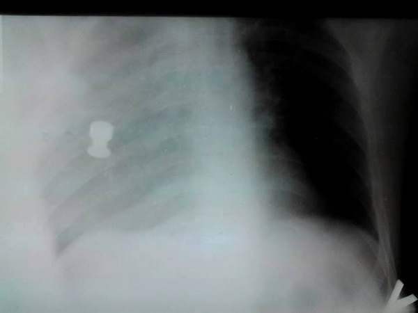 Вото фотография рентгеновского снимка, сделанная во время операции: