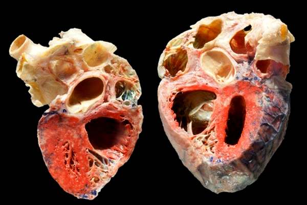 Сердце больного застойной сердечной недостаточностью не подходит для изображения на поздравительной открытке. (Фото Scientifica, I.)