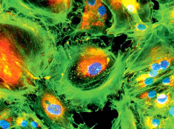 Клетки рака почки человека, которые выращивают в лаборатории для проведения экспериментов. Ядра клеток окрашены синим, а цитоплазма (внутреннее содержимое клетки) — оранжевым или желтым. В нижнем левом углу видны ядра только что разделившейся клетки (увеличение в 1800 раз). Фото: SPL/EAST NEWS