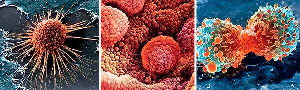 Слева напрво: 1. Переродившаяся клетка шейки матки. Смертность от рака шейки матки около 50%. Каждые две минуты в мире умирает его жертва. Изобретение вакцины от вируса папилломы человека, который увеличивает риск развития этого типа рака, привело к сокращению числа заболевших  2. Клетки рака простаты. Ежегодно этот вид рака находят у каждого шестого мужчины. Около 91% заболевших после постановки диагноза живут более 15 лет  3. Клетки рака легкого в процессе деления. Этот рак занимает второе место по распространенности. Около 85% всех умерших от рака легкого — курильщики.  Фото: SPL/EAST NEWS (X3)