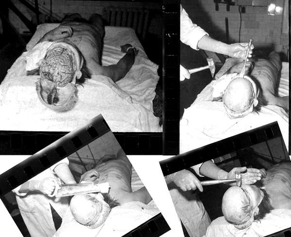Лагерь Бутугычаг. Медицинские эксперименты на мозге заключенных. Фото из архива НКВД.